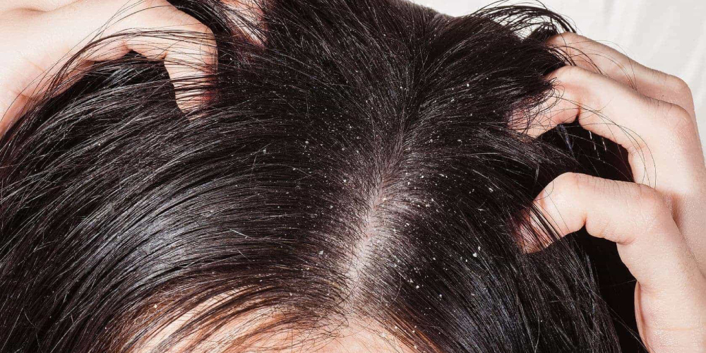 dandruff-homeopathy-treatment-panvel