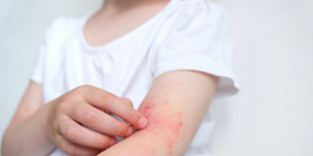 dermatitis-diathesis-homeopathy-treatment-panvel