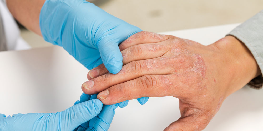 eczema-dermatitis-homeopathy-treatment-in-panvel