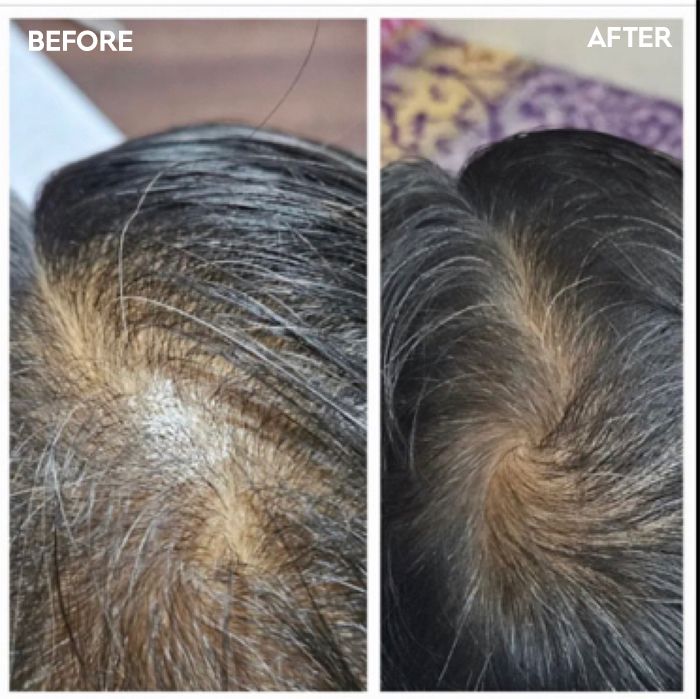 images-3--hair-prp-dr-tushar-ratnakar