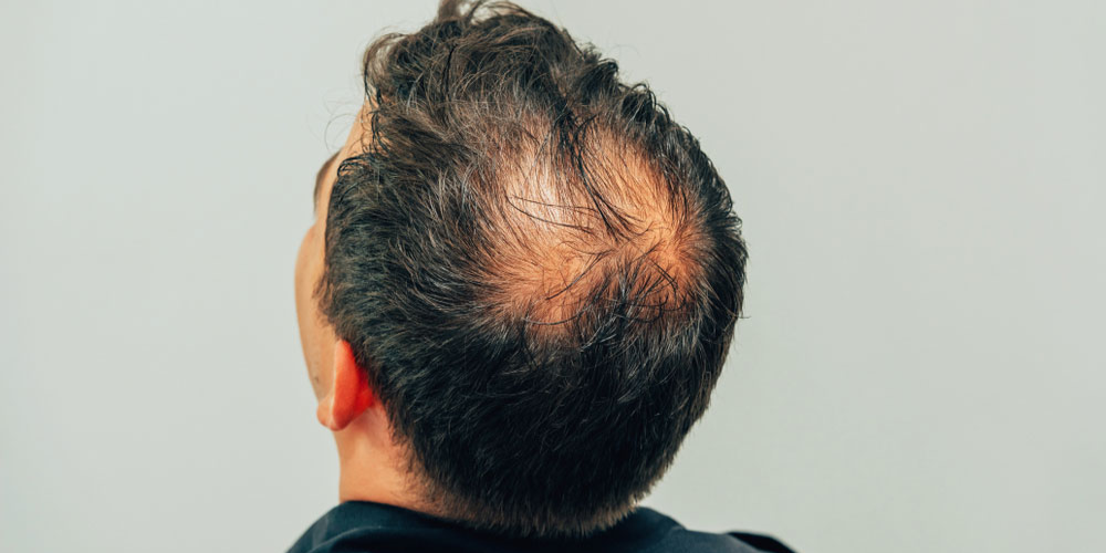 Top Homeopathic Doctor for Hair Loss or Alopecia in Pavnel, Navi Mumbai Top Homeopathic Doctor for Hair Loss or Alopecia in Pavnel, Navi Mumbai