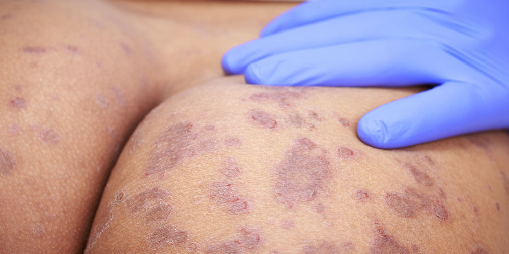 ringworm-of-the-skin-closeup-fungal-infection-homeopathy-treatment-panvel