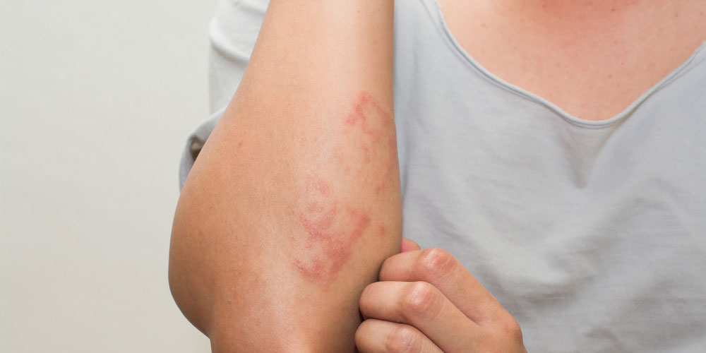 Best Homeopathic Treatment for Skin Rashes and Allergies