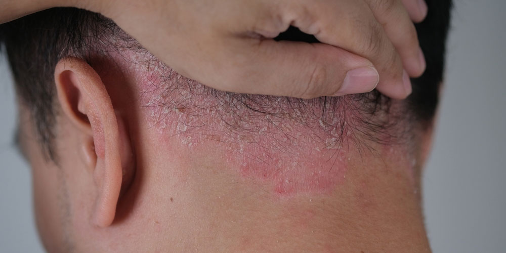 skin-with-psoriasis-homeopathy-treatment-panvel
